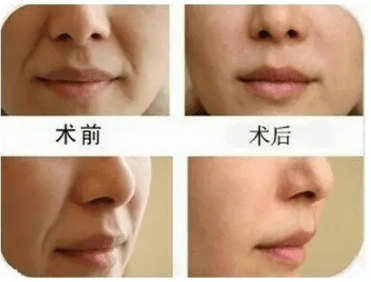 脸部医美风靡世界，爱美，女人有错吗？