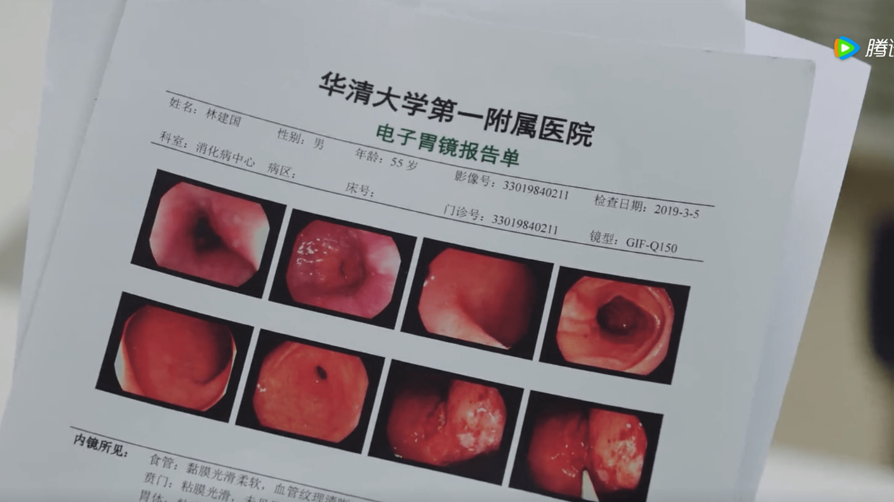 胃溃疡胃镜报告单图片