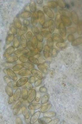 进行|男子春节后腹痛发热，检查肝脏“被掏空了”，切开后医生头皮发麻