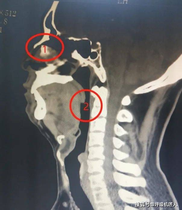 咽部ct,1为鼻气道,2为咽气道这里的气道,就是我们的上气道,包括你鼻