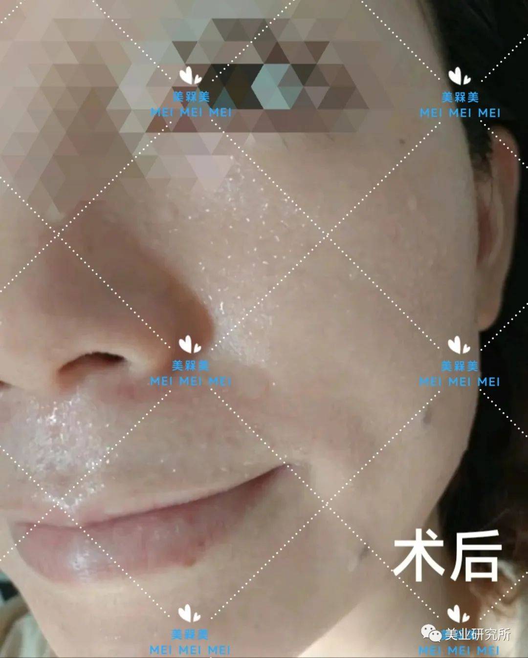 产品【美人汇】盲目跟风惹大祸，小心成为“激素脸”