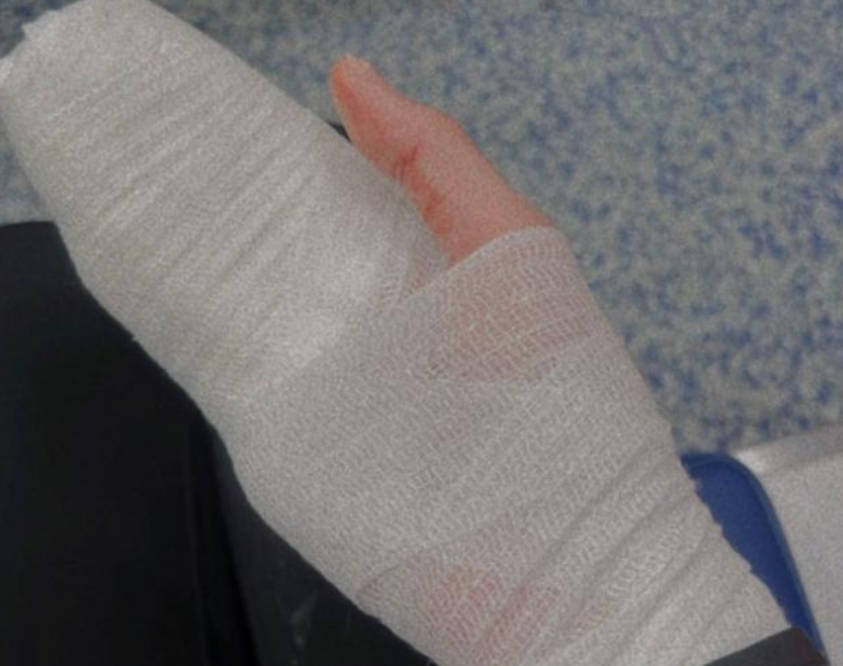 之后,邓美欣在他的个人社交账户上拍下了他手上缠着纱布的照片,并透露