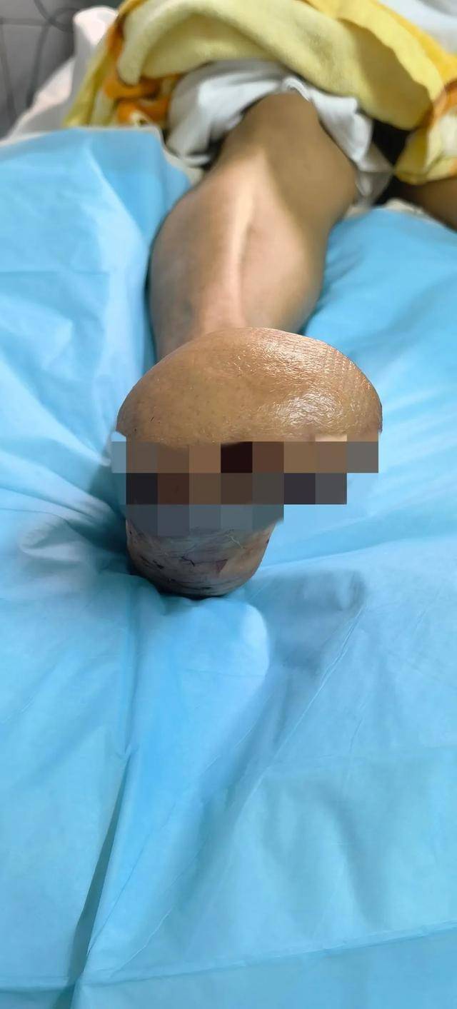 "其实,在临床上,王女士的这种冻伤情况,我们完全可以采用截肢这种最