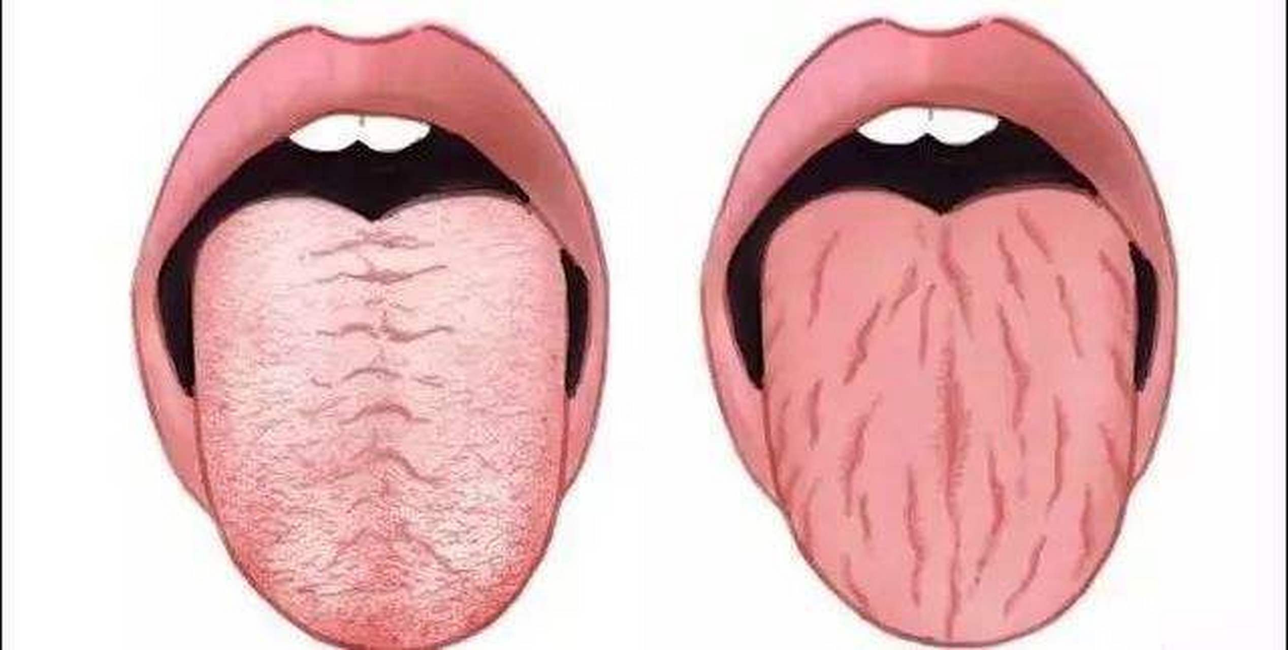 口干口渴喝水都不管用我用1瓶蜂蜜解决了裂纹舌