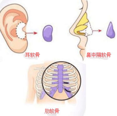 变形关于隆鼻选择那种材料比较好