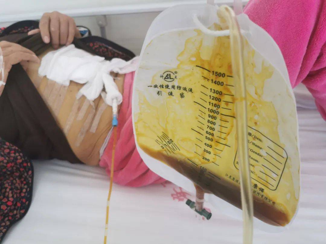 术前情况:已于外院行ptcd引流,引流管渗漏至体外,患者黄疸再次加重