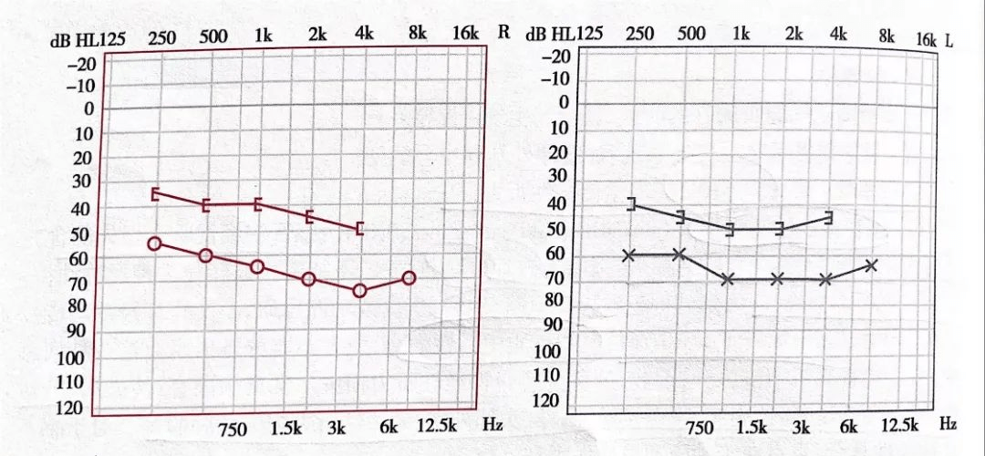 还不会看听力图?手把手来教你看(下)_损失_病变_患者