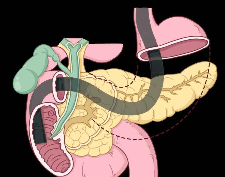 原創癌王胰腺癌善於偽裝生存率僅1呼籲這些症狀別當成胃病