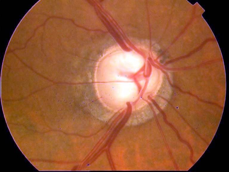 视神经萎缩眼科上的绝症