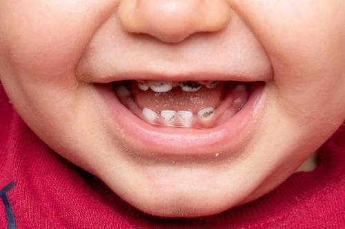 孩子什么时候换牙避开三个忽视遵循三要点换牙情况早知道