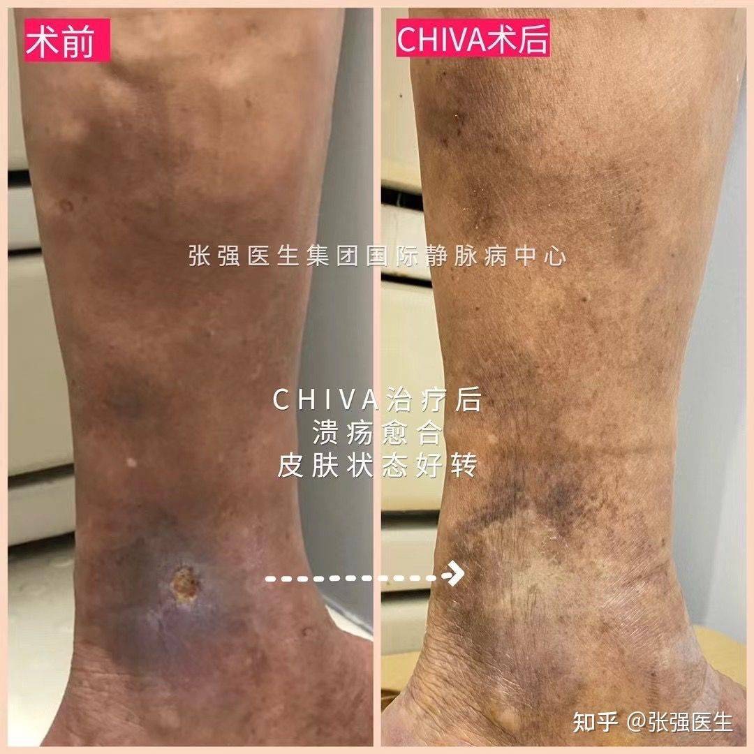 重症静脉曲张的克星chiva治疗背后的医学逻辑