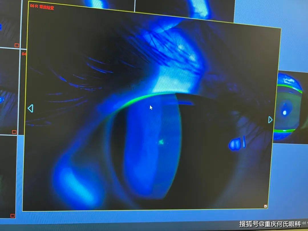 来到重庆何氏眼科医院检查后发现,小伊的右眼角膜中央出现小片状点染