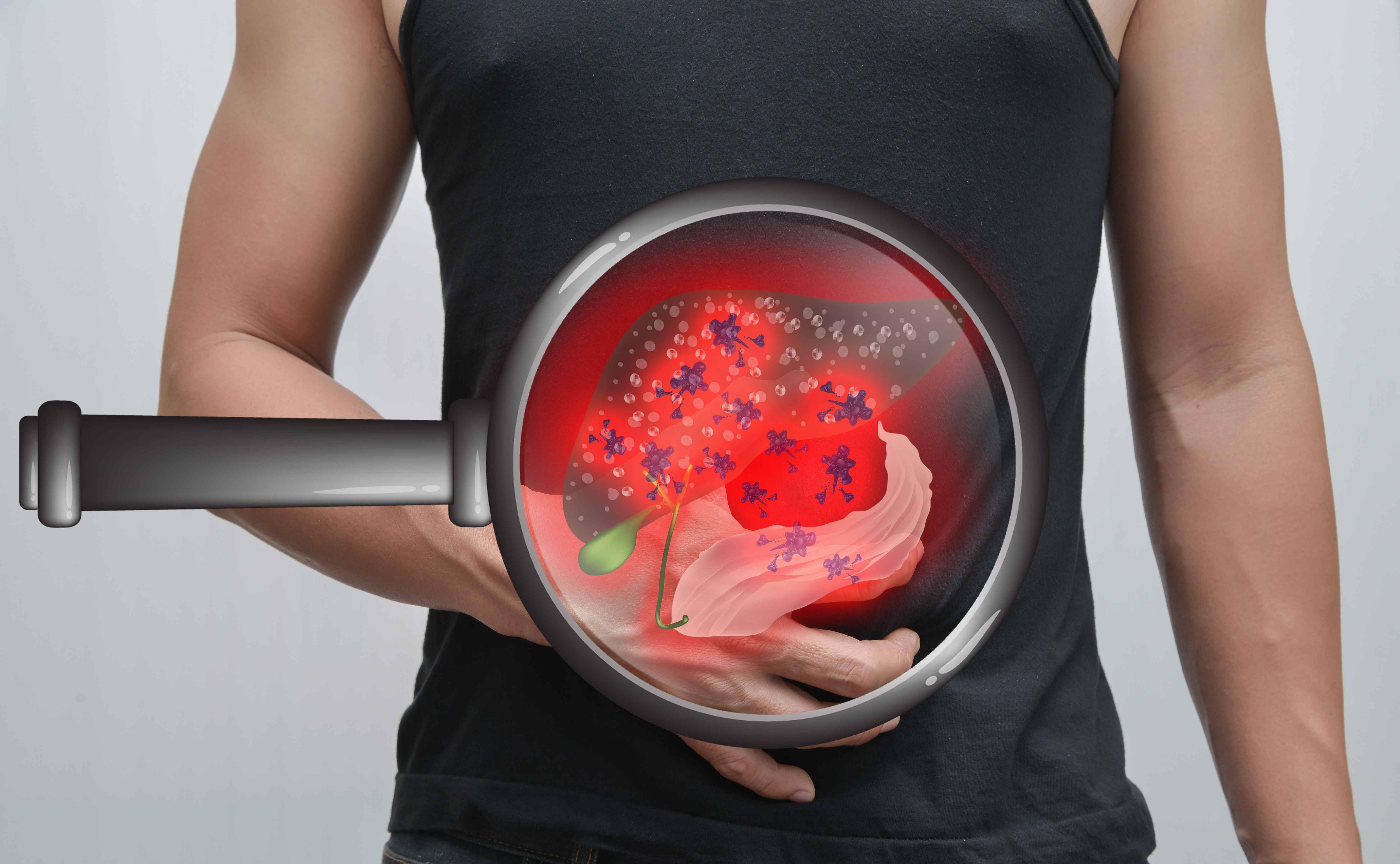 原创肝癌的病发率与死亡率居高不下医生仍不戒酒肝癌基础更牢