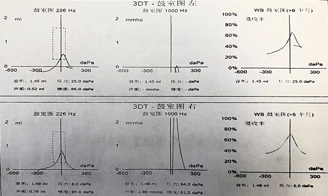 耳蝸內廣泛存在耳蝸死區的聽損者如何進行聽力改善