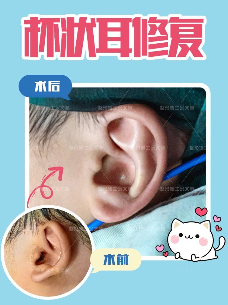 【杯状耳】折耳猫可爱,如果人的耳朵也长这样还会可爱吗?