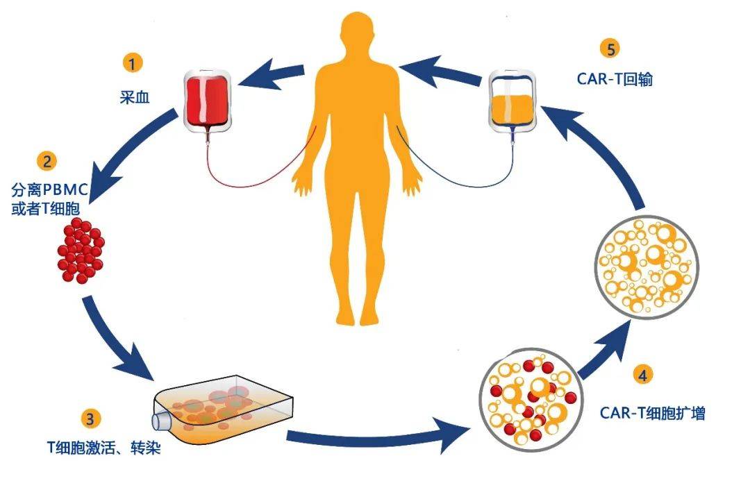 结直肠癌car-t产品:gcc19cart获美fda授予快速通道资格_治疗_患者_斯