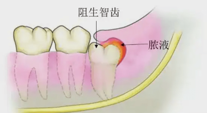 智齒到底要不要拔都腫的合不上嘴了