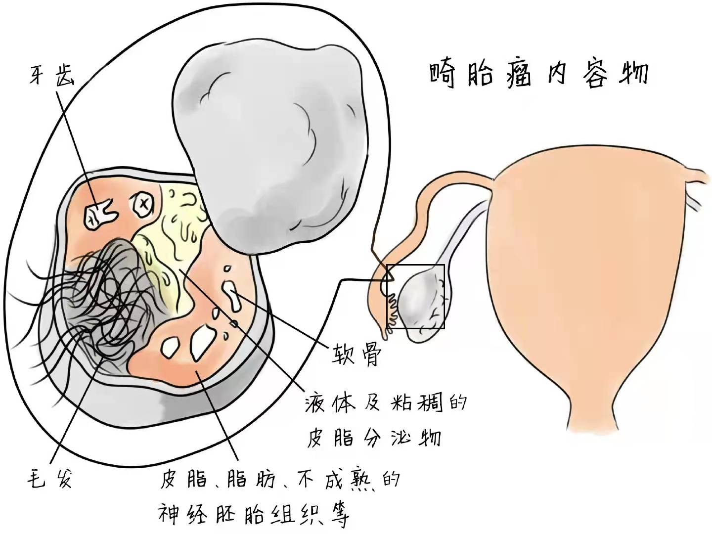 畸胎瘤不等于怪胎,早发现早干预!