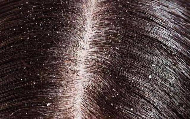 支你一招轻松解决!_头皮屑_皮肤_屏障