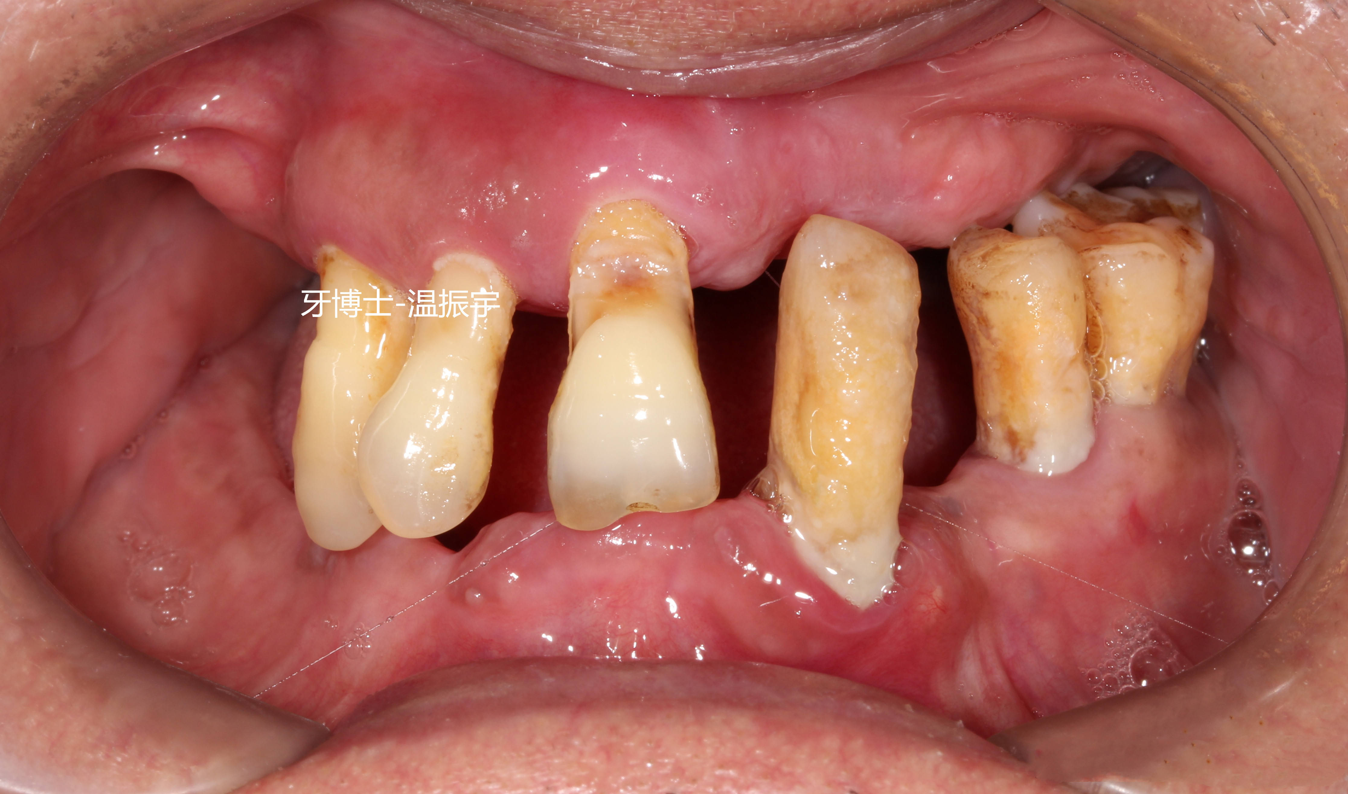 最烂的牙齿可以有多烂
