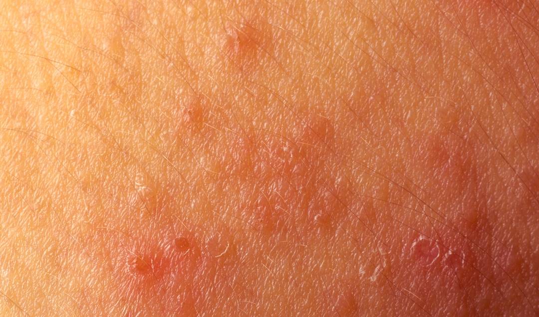 肛门湿疹挺难为情,但屁股反复瘙痒,最好多注意这4点,早治疗_进行_疾病