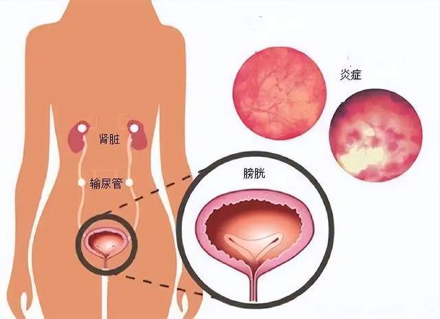 姨妈刚走它又来串门小便问题频繁来扰怎么办