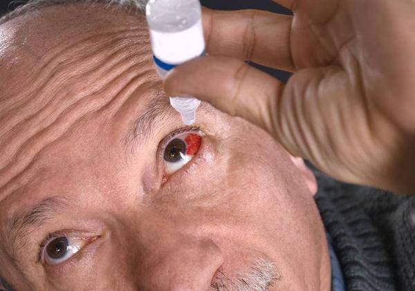 “红眼病”就是结膜炎?医生:结膜炎通常有这几种类型,要分清楚_患者_发病_症状