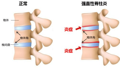 细胞学院世界强直性脊柱炎日干细胞临床治疗效果显著