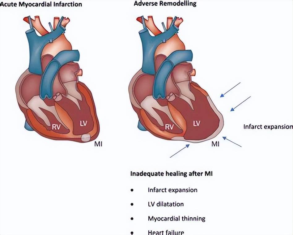 45岁女性心悸胸闷心前区痛检查结果都正常可能是什么病