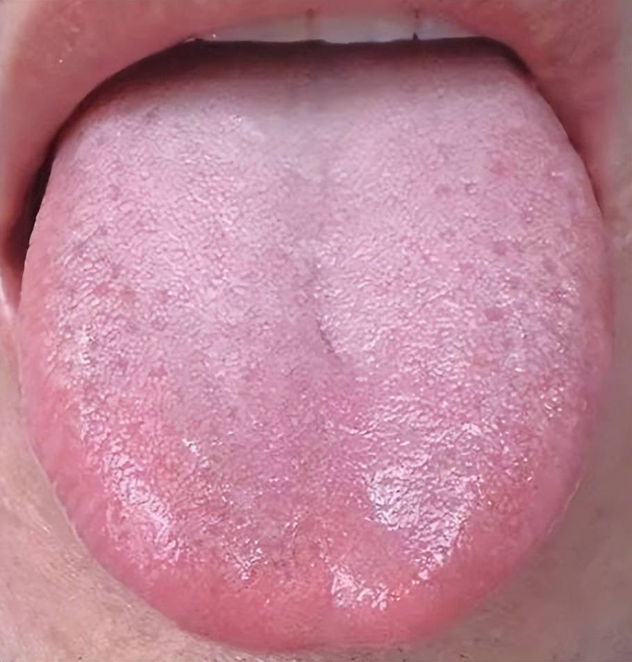 舌苔厚腻且有齿痕 是什么问题 教你看舌苔辨健康 舌头 类食品 乳头