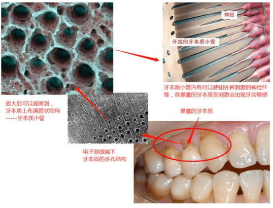 牙本质小管暴露图片