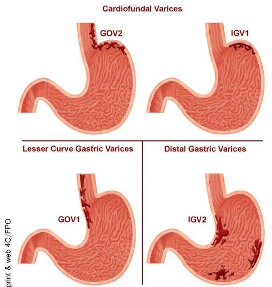 胃的四个分型图片图片