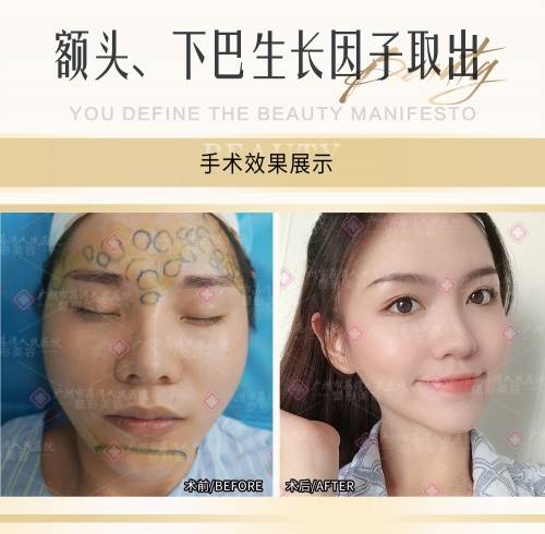 生长因子取出,邓正军实例解析如何修复_面部_部位_小宋