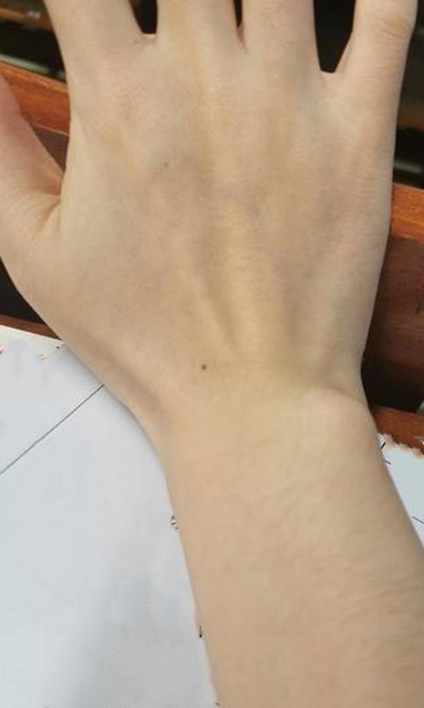 上肢远端及手掌背部灼热感是什么原因?