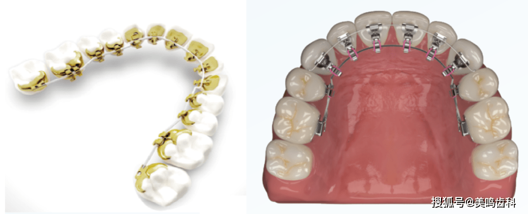 不同的是这种保持器由技工利用树脂和弯制钢丝完成,同样也分上下两