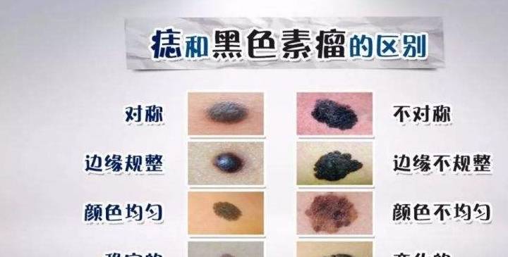 如何分辨黑色凸起痣的良恶性？4点快速辨别！_变化_肿瘤_饮食