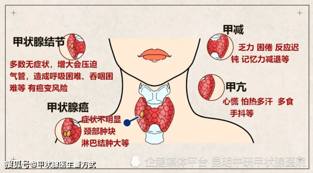 国际甲状腺疾病知识宣传周启动甲亢甲减比甲减更青睐女性