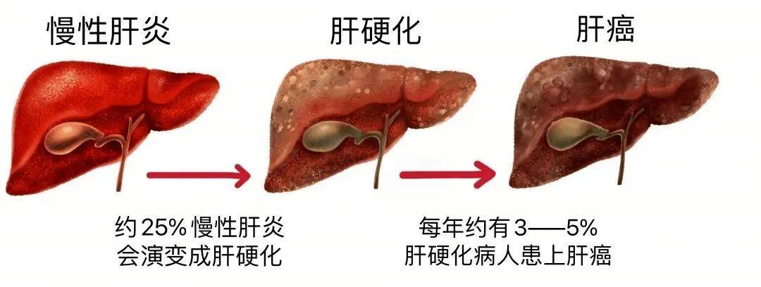 阻断肝炎三部曲,肝癌早期筛查,规范诊治尤为关键