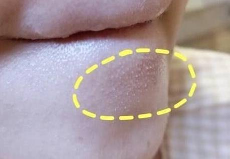 下巴上长出的“白色颗粒”，可能不是螨虫分泌物，或和你想的不同