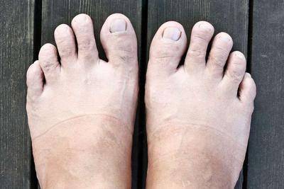 体内有疾，脚趾”先知“若发生这3种“信号”，可能是癌细胞“露出马脚”
