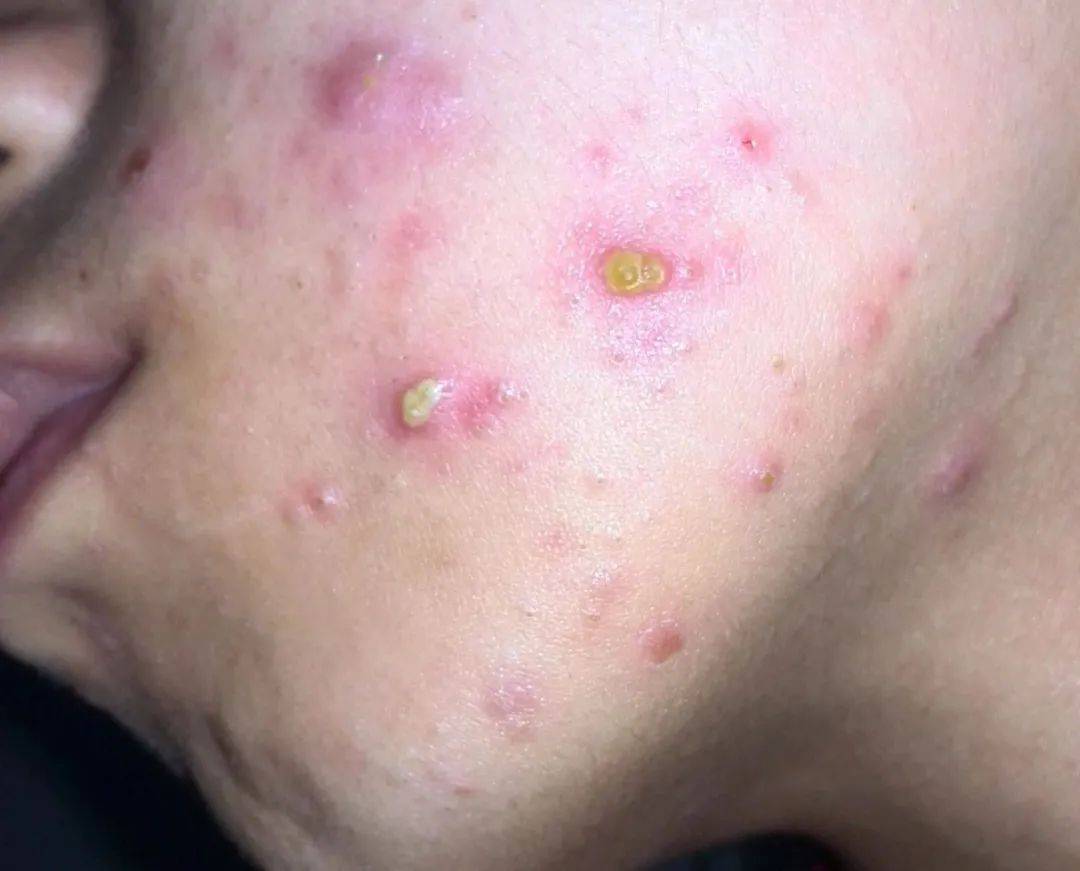 皮油痘痘多做本色肤雕 | 宇彤分层抗衰 | 宇彤护肤_护理_油脂_皮肤