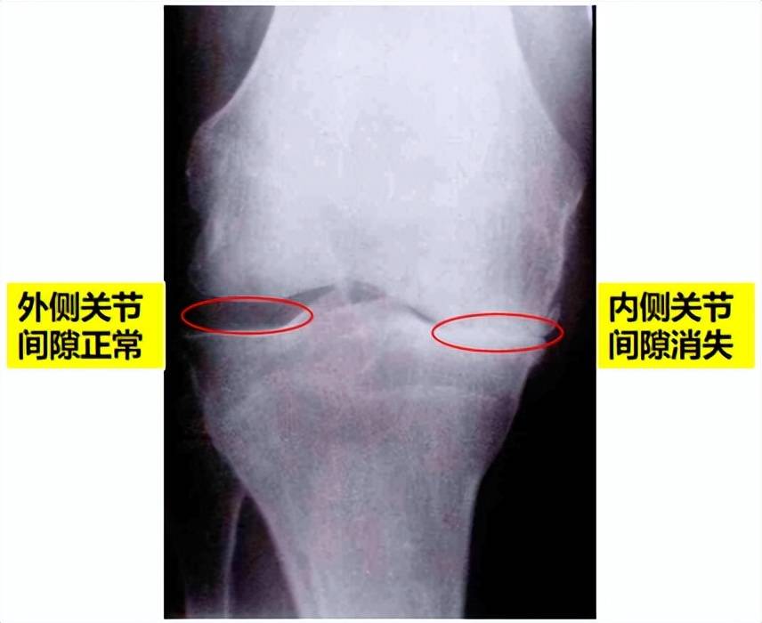 大夫我的膝关节间隙为什么变窄了能救吗