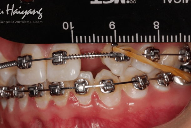 正畸牽引聯合氧化鋯基臺修復雙側側切牙缺失1例愛迪特跨學科臨床病例