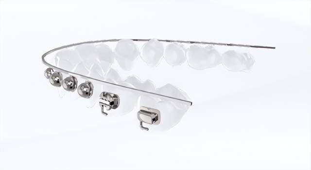 欧欧球面自锁托槽学生暑期矫正你想知道的都在这里