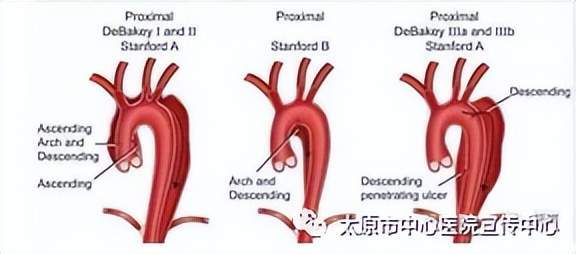 心胸大血管外科独立完成一例a型主动脉夹层的改良孙氏手术