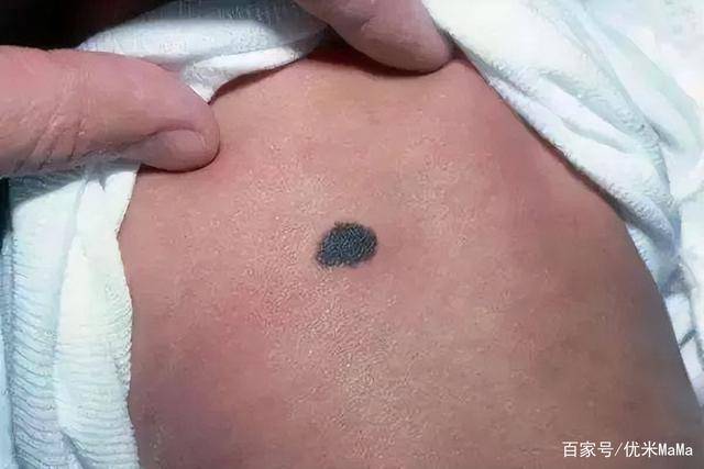 孕期3种行为容易引起宝宝胎记准妈妈尽量避开以防孩子自卑