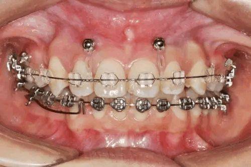 为什么有的人矫正牙齿还需要打骨钉 前牙 钉子 缝隙