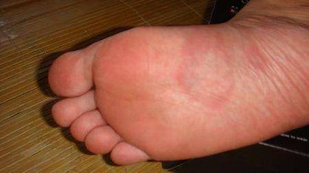 脚底有红斑可能是慢性肝炎,肝硬化等疾病引起的,肝功能持续下降