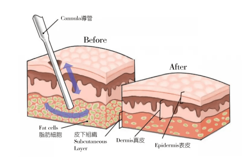抽脂副作用的修复阶段黄金修复期术后1年内是后遗症高发期,尤其是凹陷