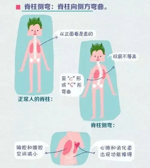 女性双乳发育不对称◆肩胛骨不等高◆长短腿◆躯干往一侧偏移◆腰线